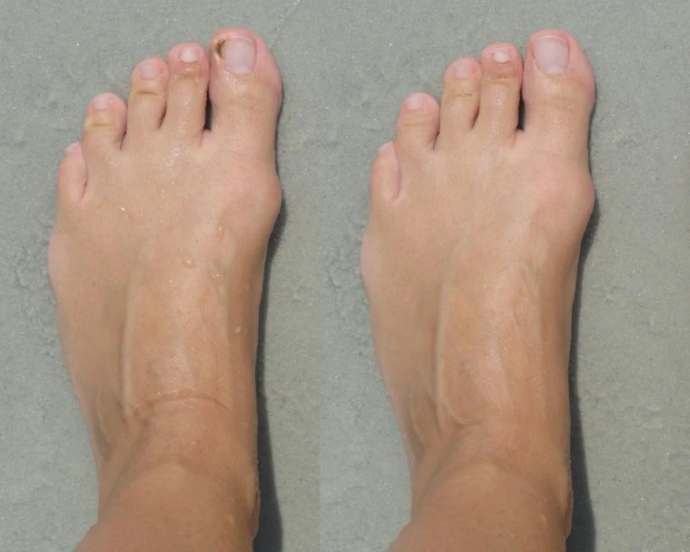 After treatment
